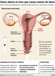 Cáncer de Cuello de Útero